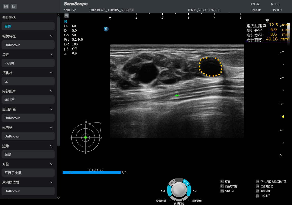 S-BREAST