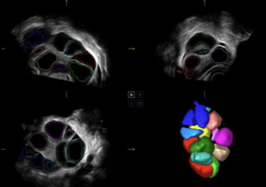 AVC-FOLLICLE