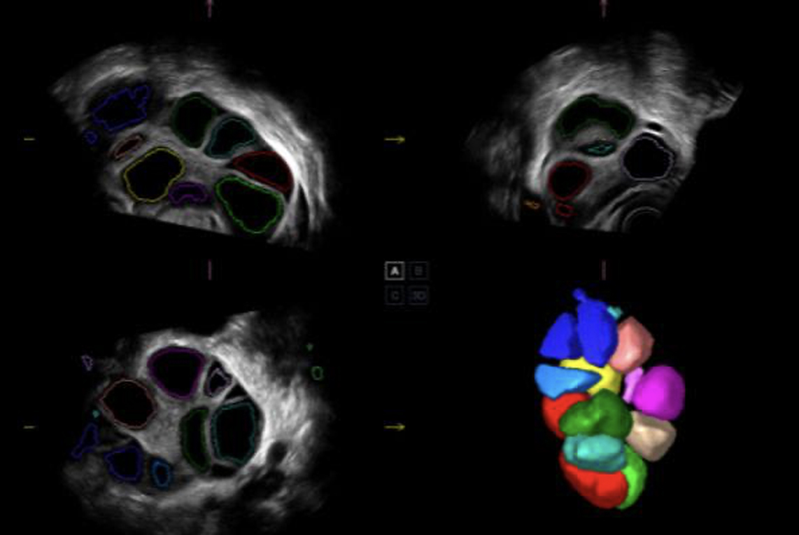 AVC-FOLLICLE