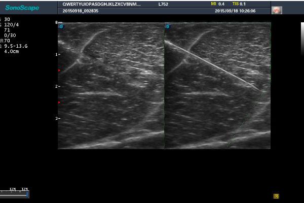 Vis-Needle