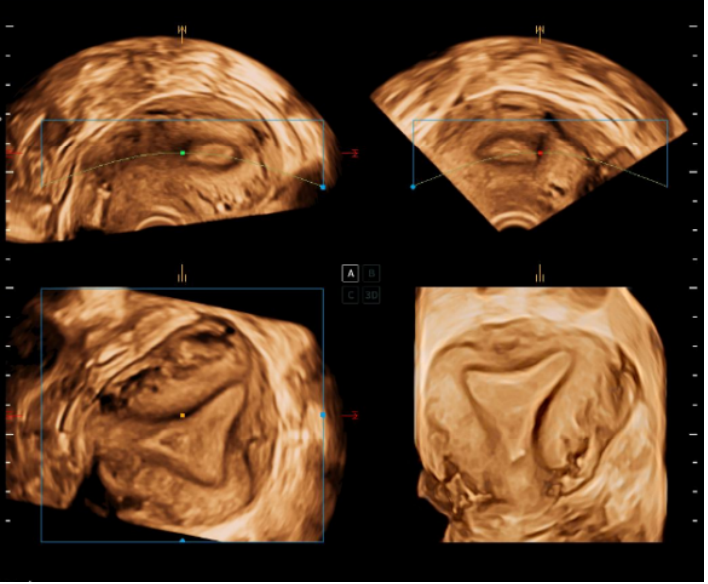 S-UTHERUS 3D